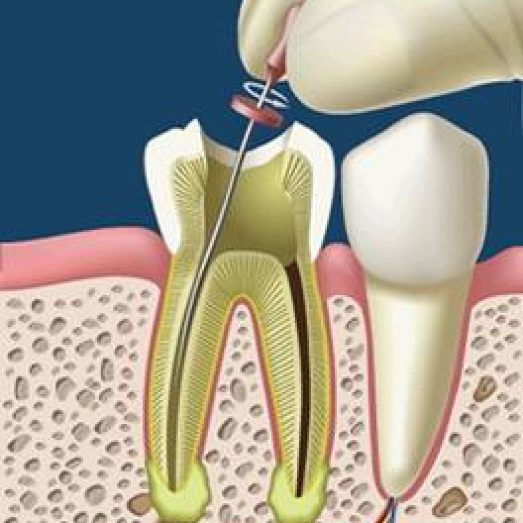 endodoncia